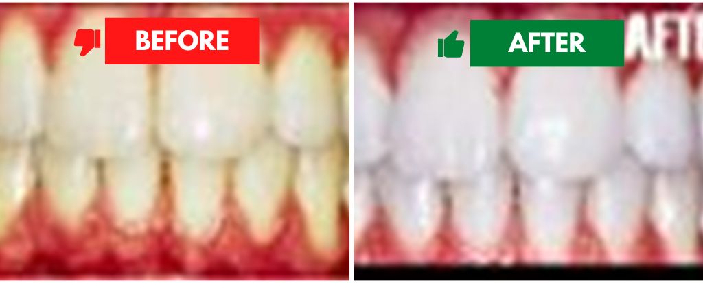 Teeth Whitening Teeth Whitening
