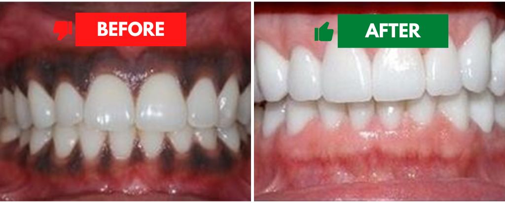 Treatment for Black Gums Treatment for Black Gums