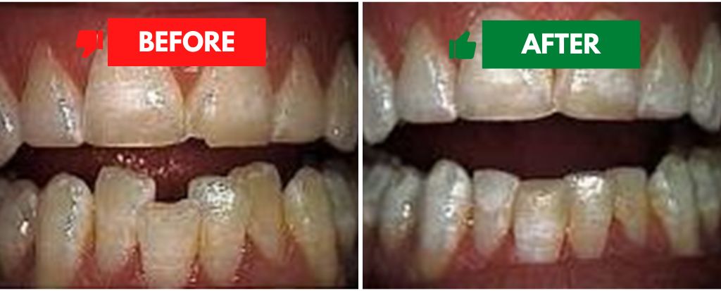 Teeth Reshaping Teeth Reshaping