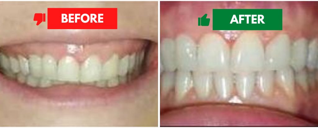Bite Correction Bite Correction