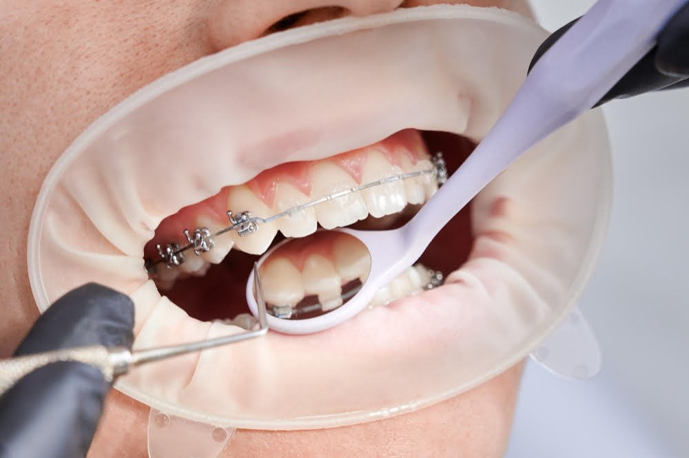 dentist attaching metal braces patient teeth 1 1 dentist attaching metal braces patient teeth 1 1