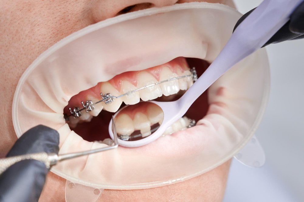 dentist attaching metal braces patient teeth 1 dentist attaching metal braces patient teeth 1