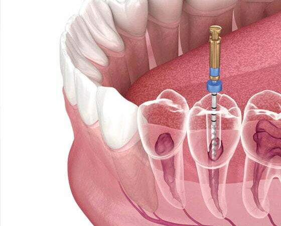 root cancal treatment bangalore 1 e1777463355687