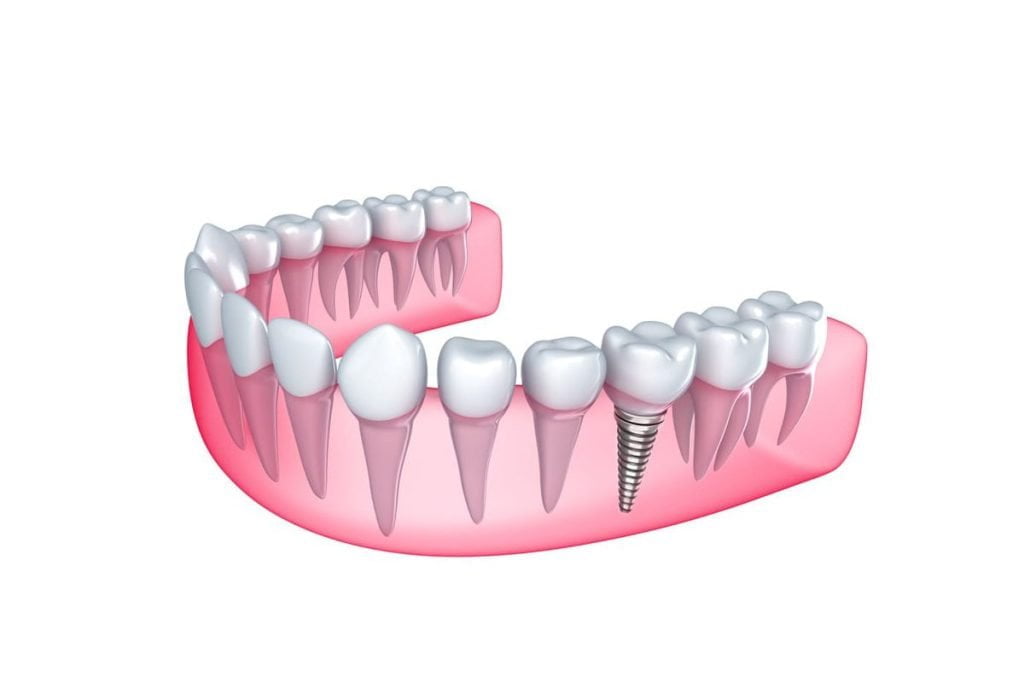 Dr. Gowds' Dental Hospitals |Dental Implants