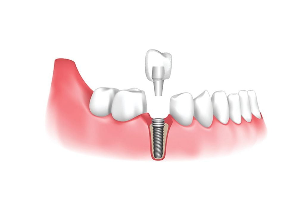 Dr. Gowds' Dental Hospitals |Dental Implants
