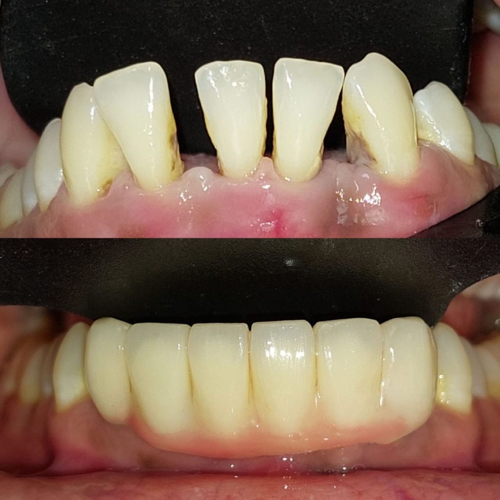Dr. Gowds' Dental Hospitals |Dental Implants