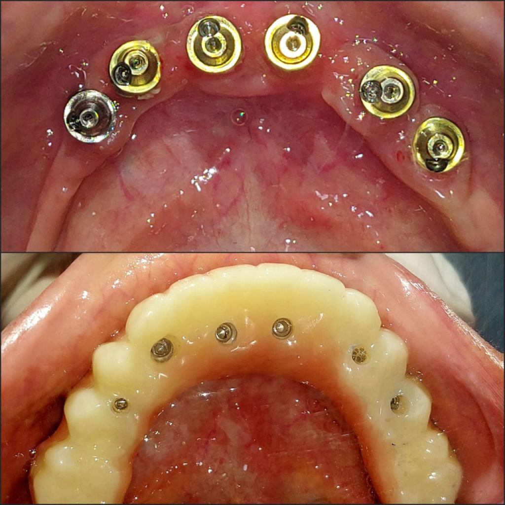 Dr. Gowds' Dental Hospitals |Dental Implants