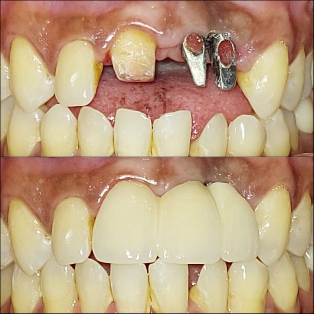 Dr. Gowds' Dental Hospitals |Dental Implants