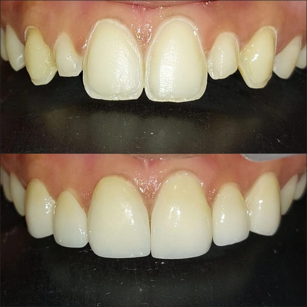 Dr. Gowds' Dental Hospitals |Dental Veneer