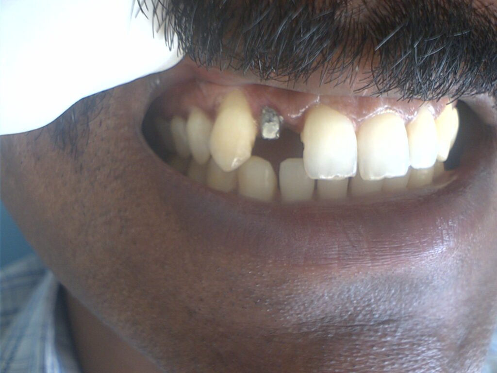 Dr. Gowds' Dental Hospitals |Braces