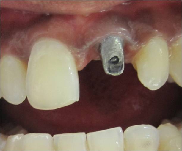 Dr. Gowds' Dental Hospitals |Braces
