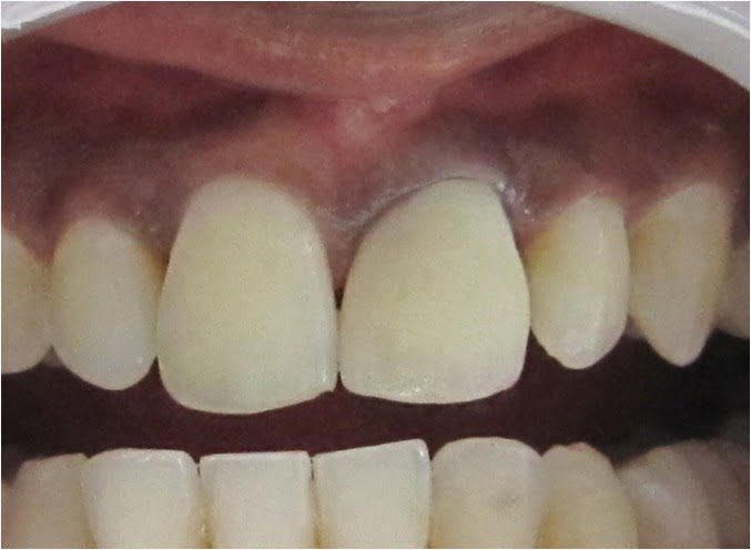 Dr. Gowds' Dental Hospitals |Braces