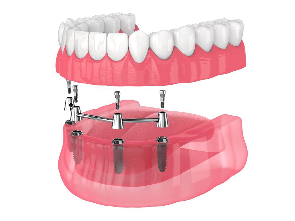 Dr. Gowds' Dental Hospitals |Dental Implants