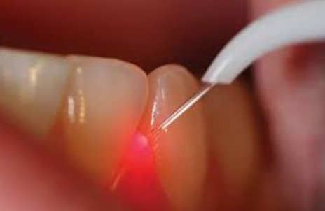 laser dentistry 500x500 1 laser dentistry 500x500 1