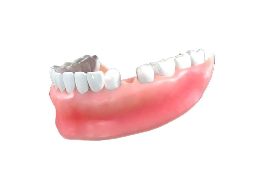 Dr. Gowds' Dental Hospitals |Dental Implants