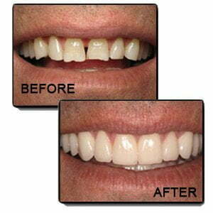 Dr. Gowds' Dental Hospitals |Dental Veneer