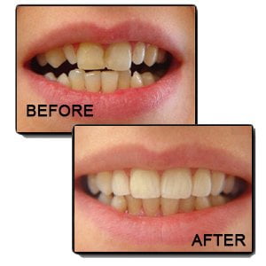 Dr. Gowds' Dental Hospitals |Dental Veneer