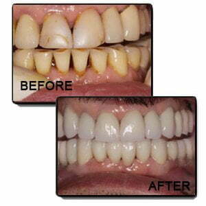 Dr. Gowds' Dental Hospitals |Dental Veneer