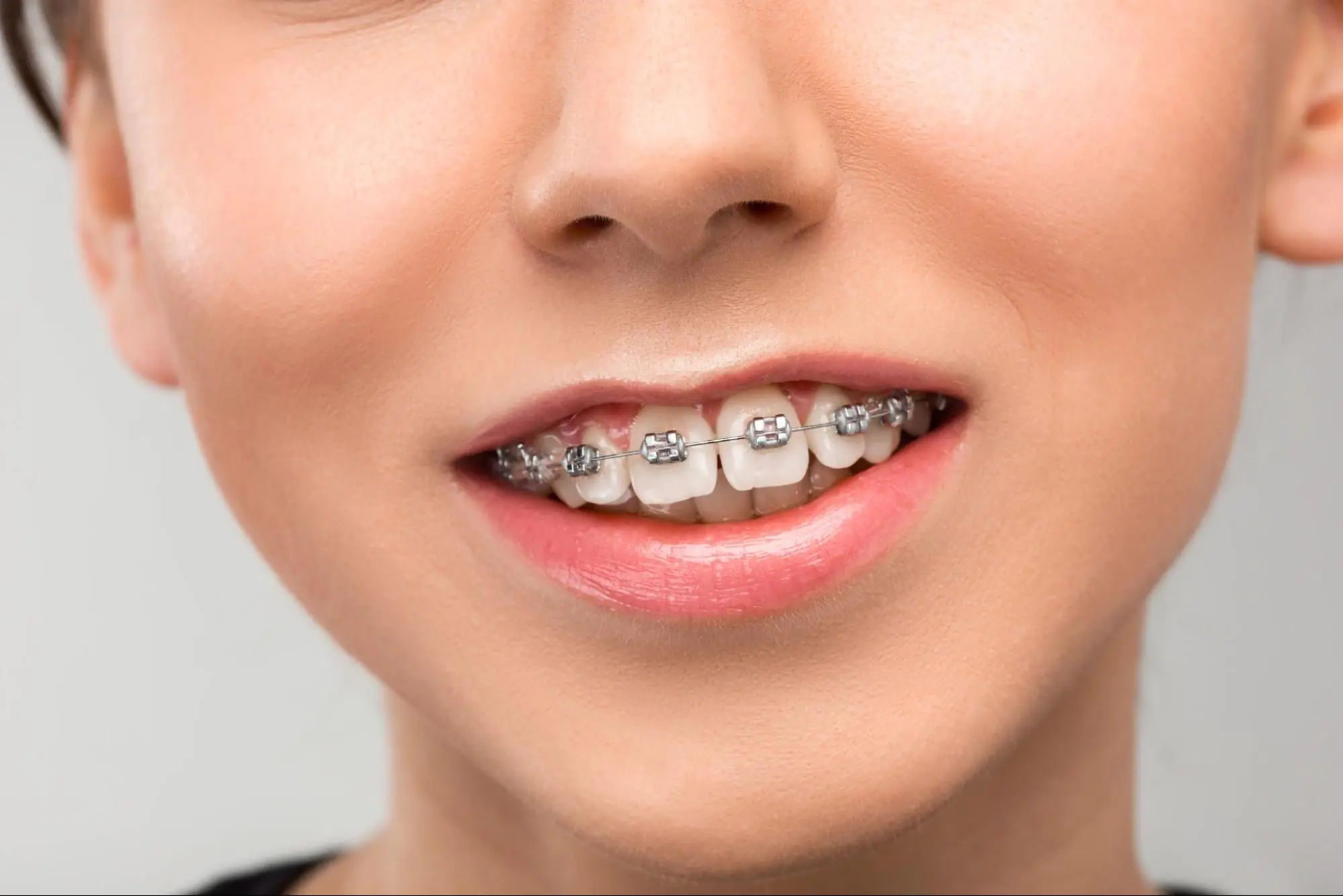 People with gaps between their teeth can get invisalign treatment People with gaps between their teeth can get invisalign treatment