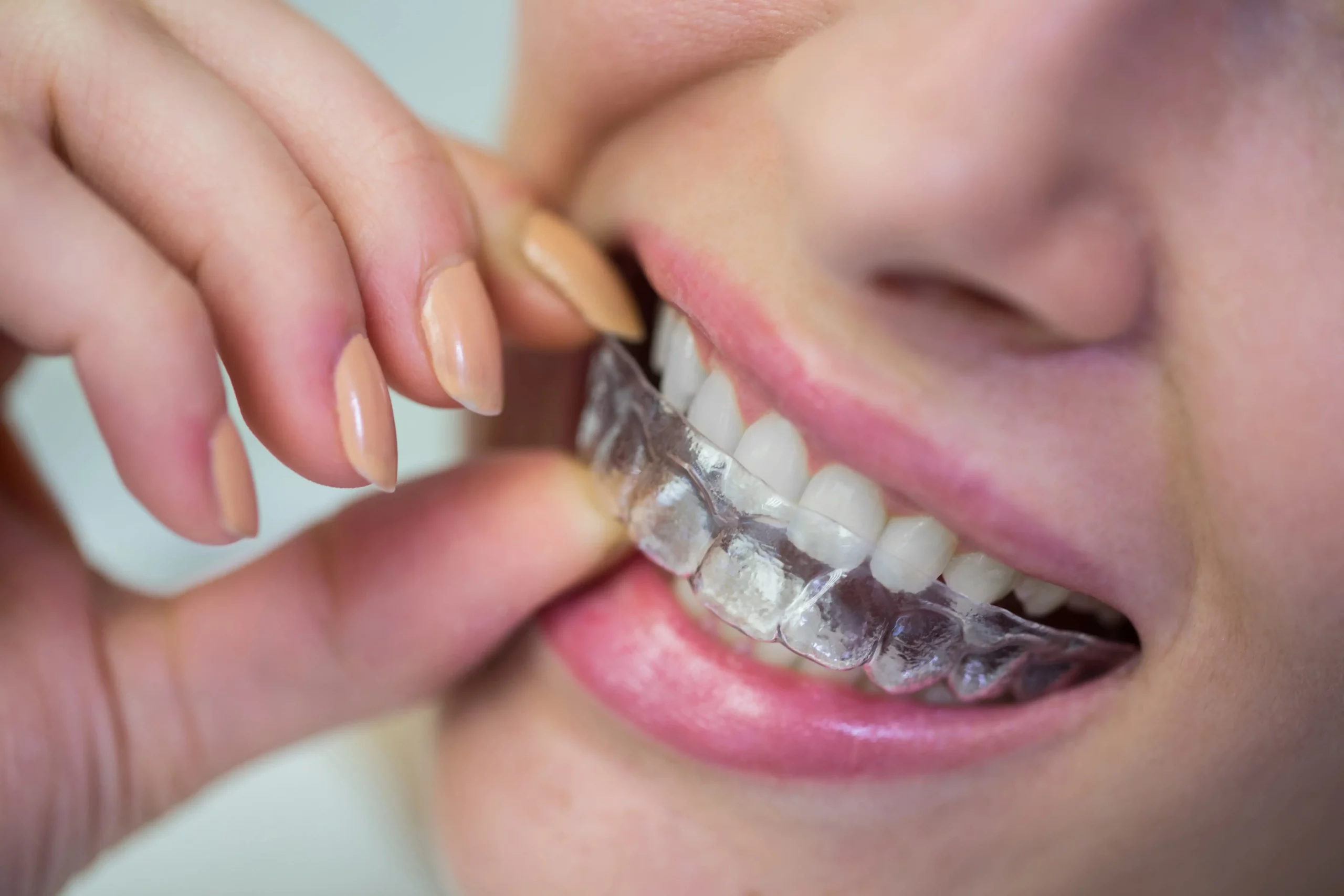 Teens and adults with mild to moderate teeth misalignment can get invisalign treatment Teens and adults with mild to moderate teeth misalignment can get invisalign treatment