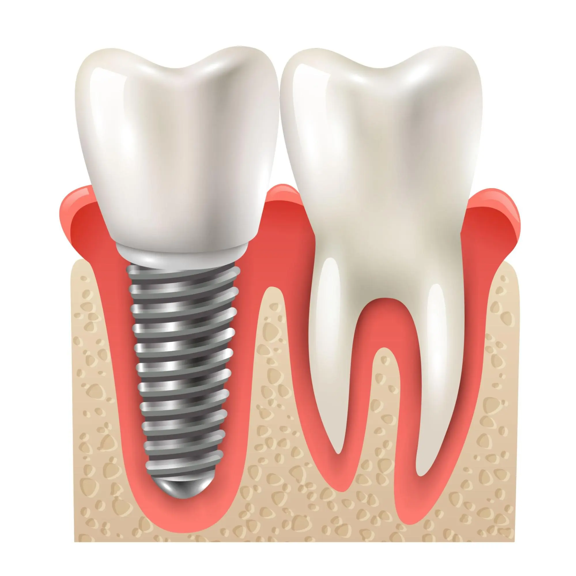 dental implants- single tooth savior