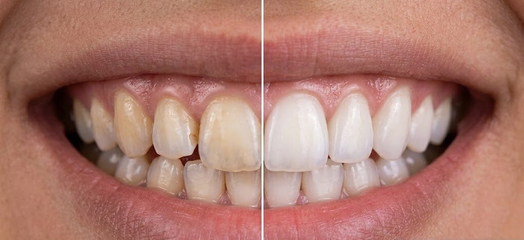 A close-up, split-screen photograph contrasting a patient's natural, slightly discolored and chipped teeth (Before) with the same teeth transformed into a radiant, perfectly white, and aligned smile (After), illustrating the core benefit of cosmetic dentistry. The transformation includes corrected chips and brighter color.